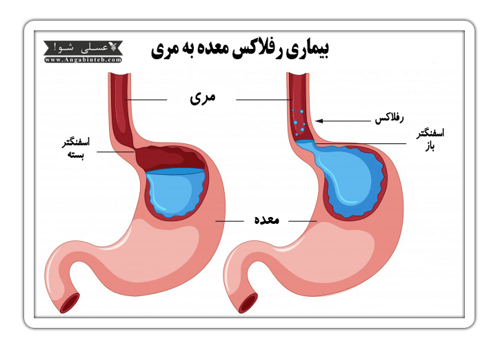 رفلاکس معده