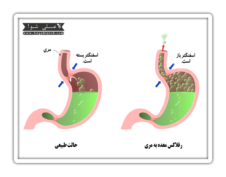 درمان رفلاکس معده