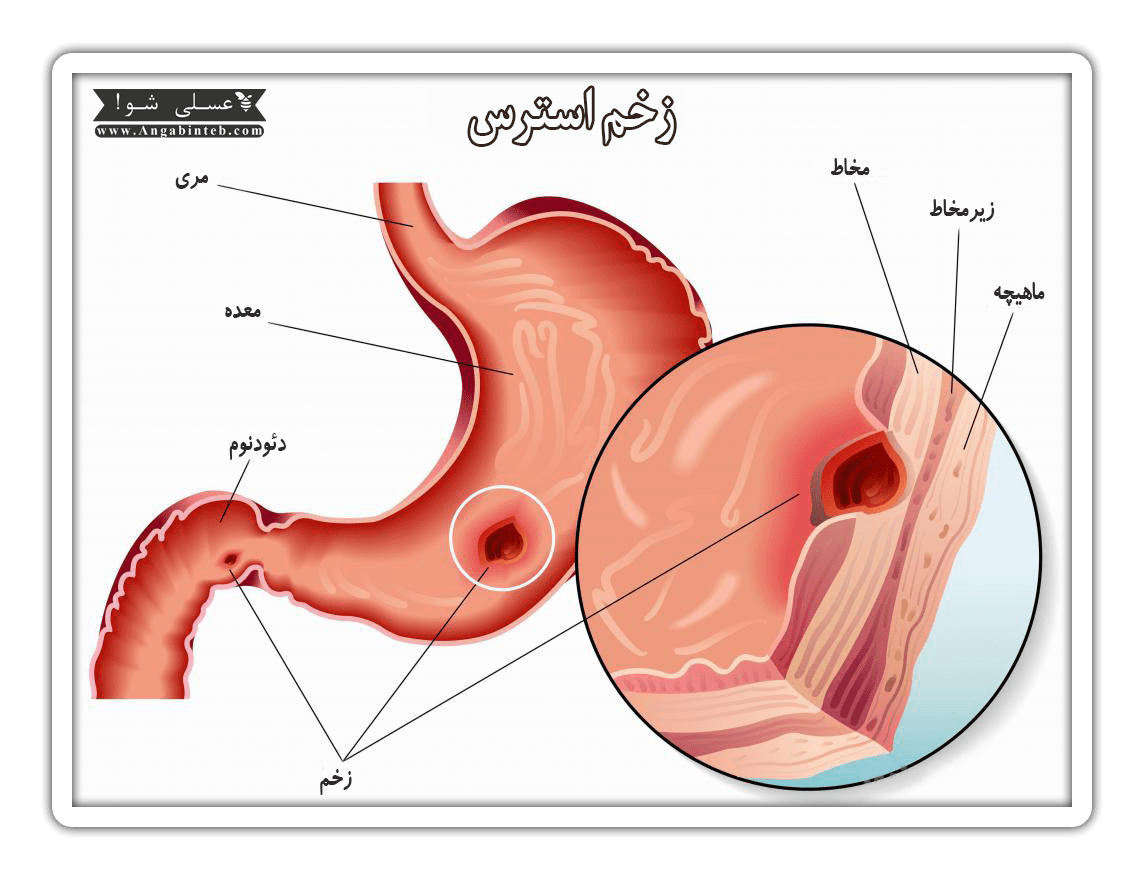 زخم استرس