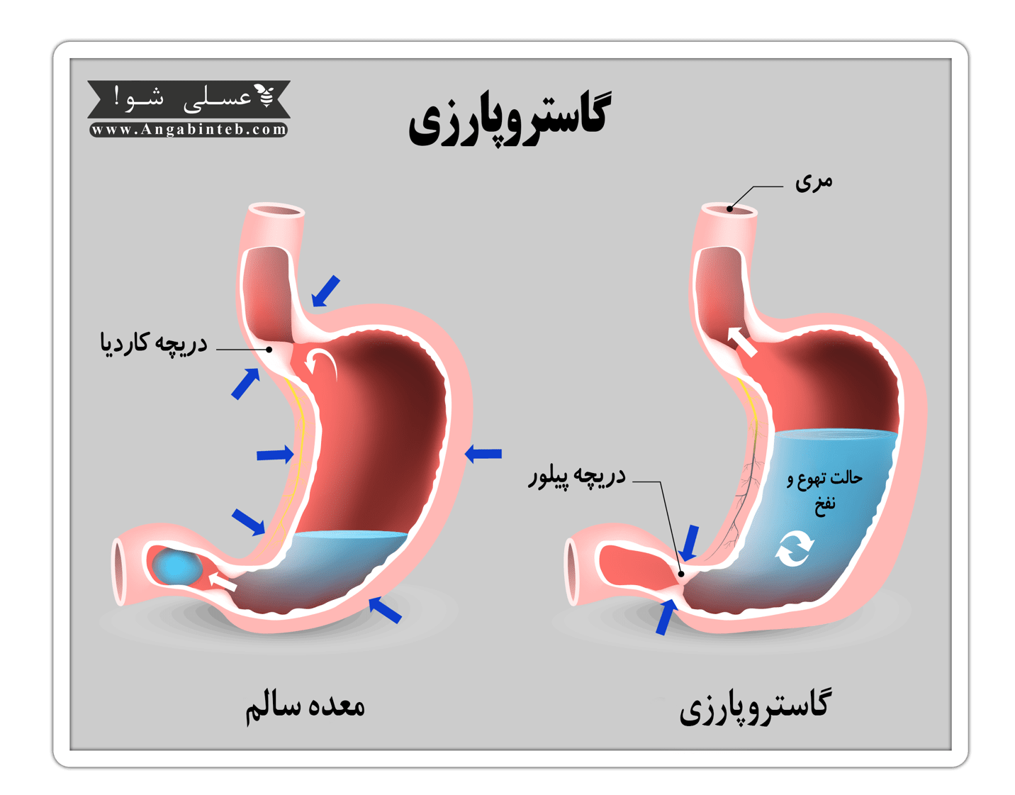 علت بیماری گاستروپارزی