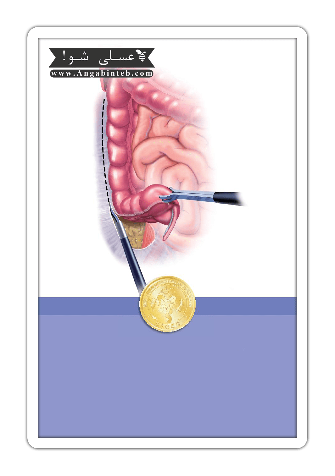 SmallBowelResection4