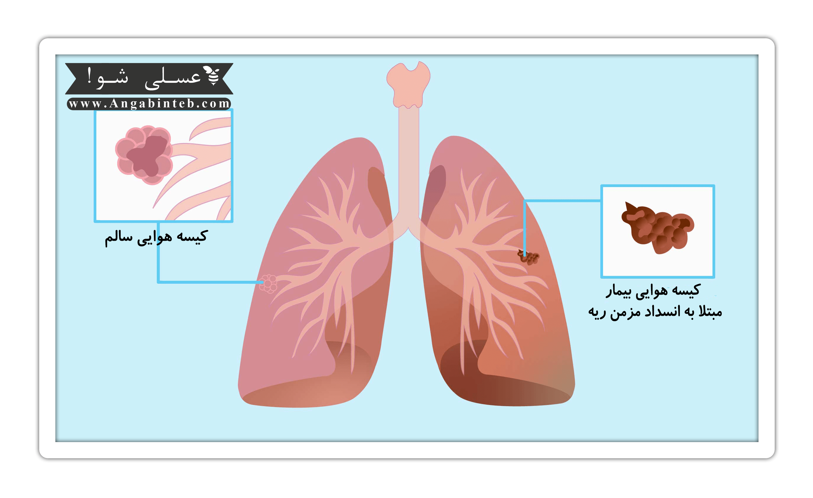 copd-sign-min