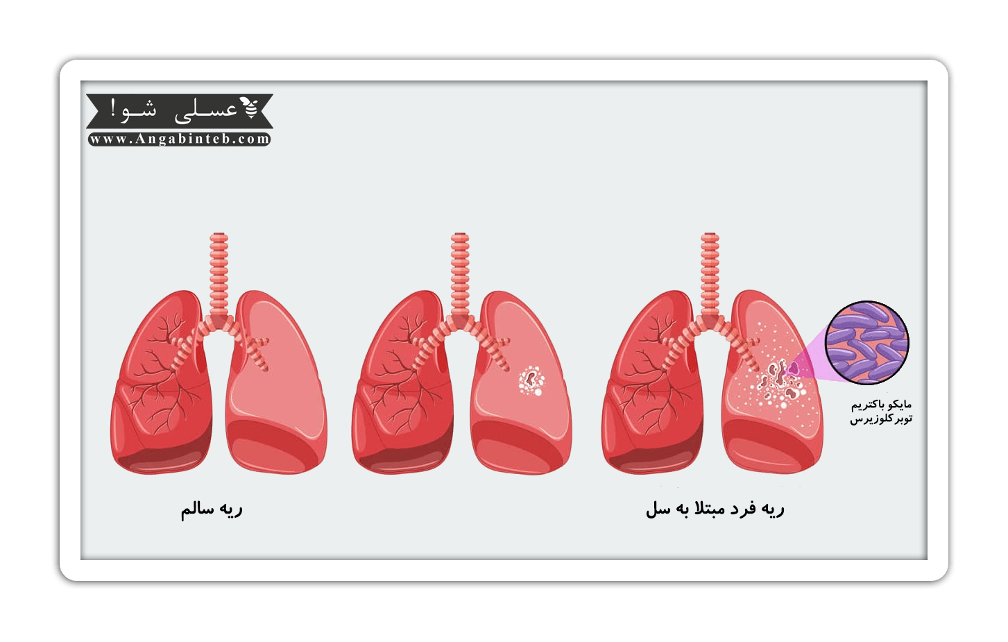 Tuberculosis-end