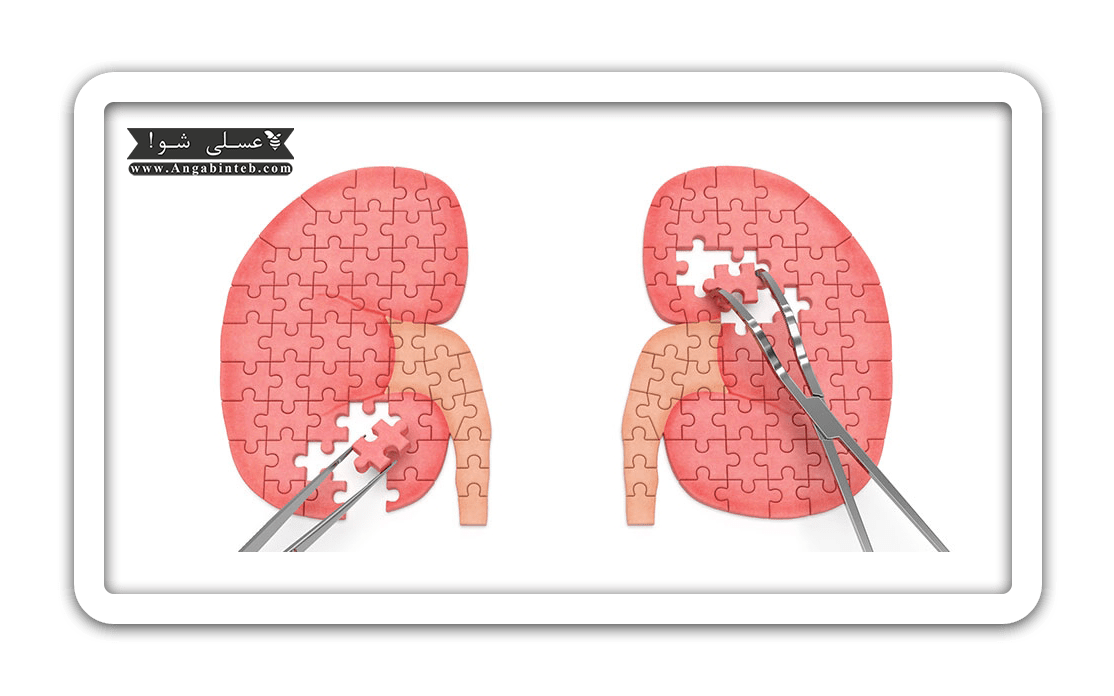 KidneyTransplant-How-min.png