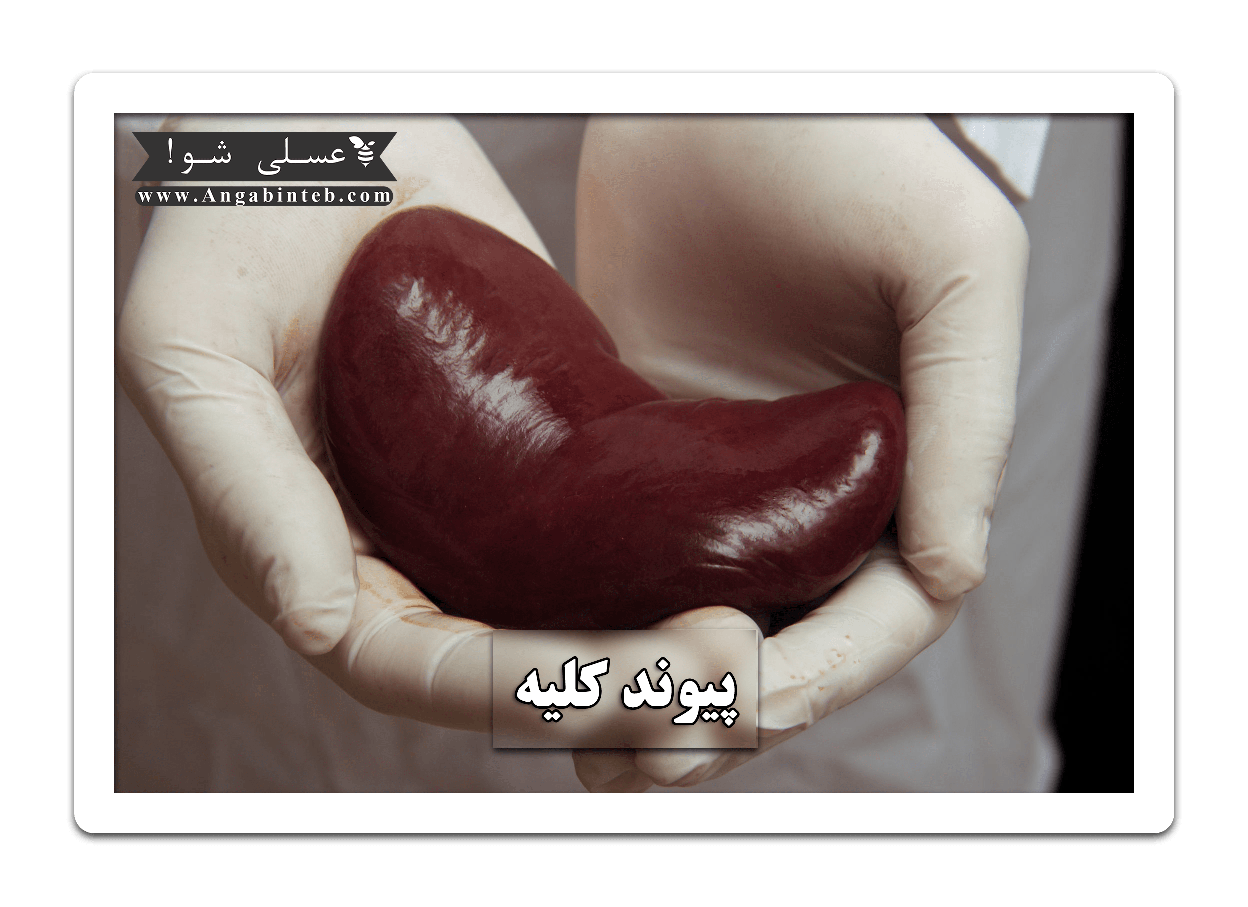 KidneyTransplant-Title-min