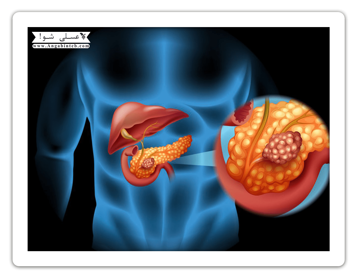 Cancer-Pancreas-min