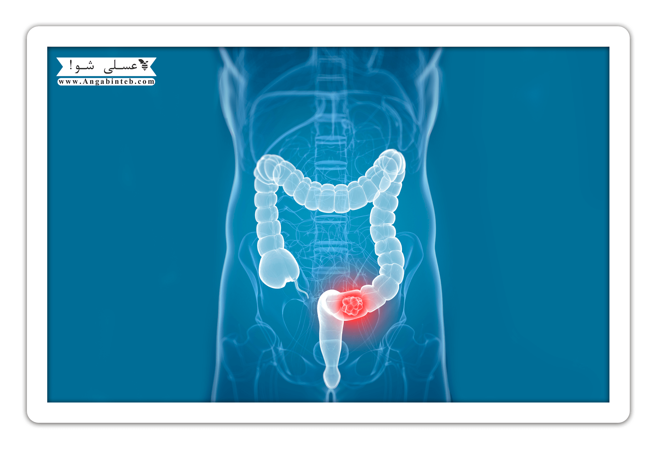 Cancer-colorectal-min