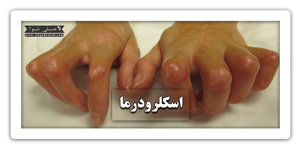 Scleroderma-title-min