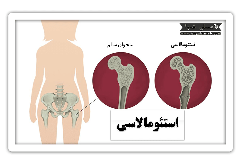 Osteomalacia-Title-min