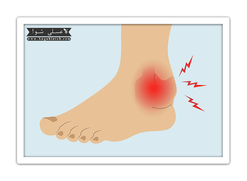 RheumatoidArthritis-DarRaftegi-min