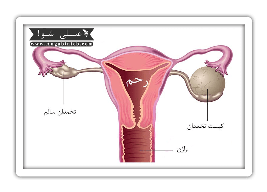 Ovarian%20Cysts-3-min.png