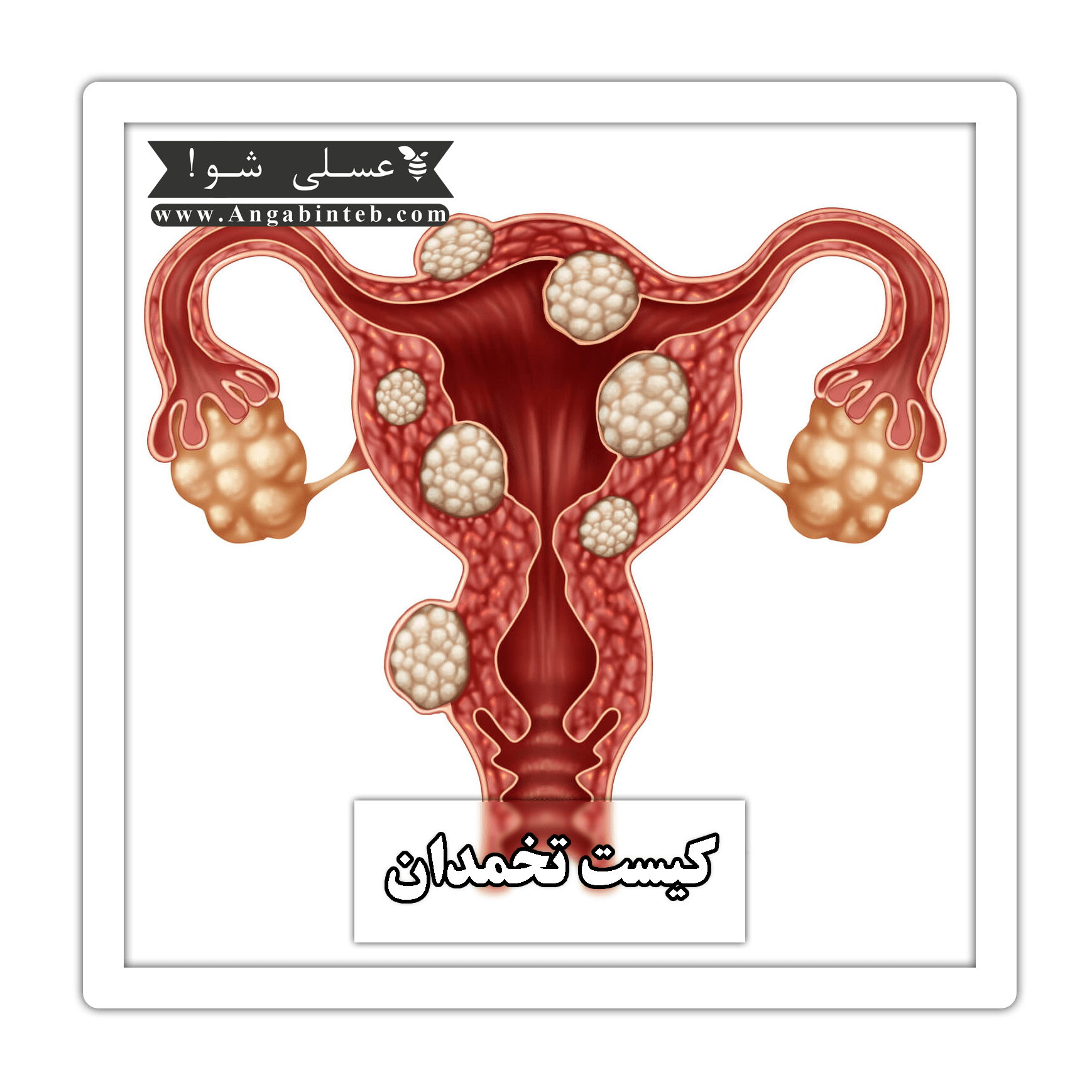 Ovarian%20Cysts-title-min.png