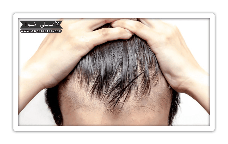 HairLoss-Causes-min