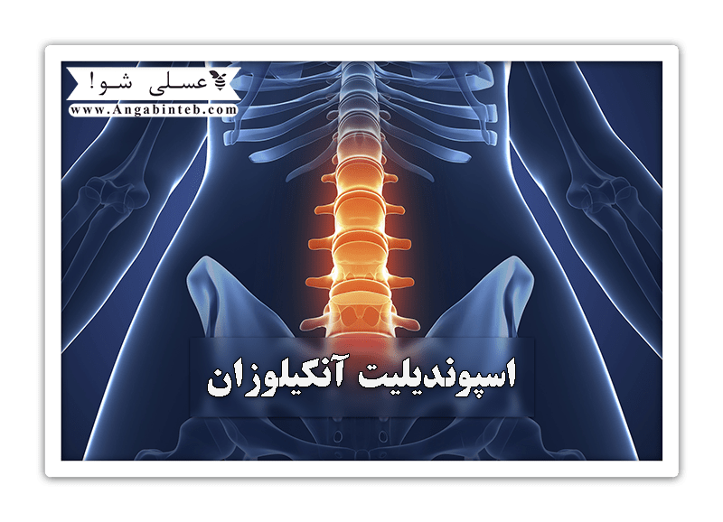 AnkylosingSpondylitis-Title-min