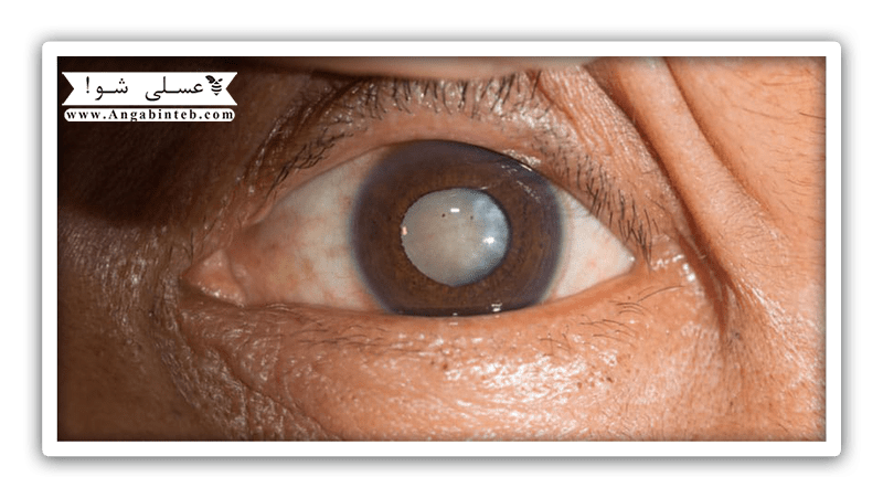 VitaminB2-Cataract-min