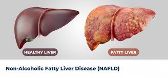 ارتباط بین کبد چرب غیر الکلی و بیماری سرطان کولورکتال