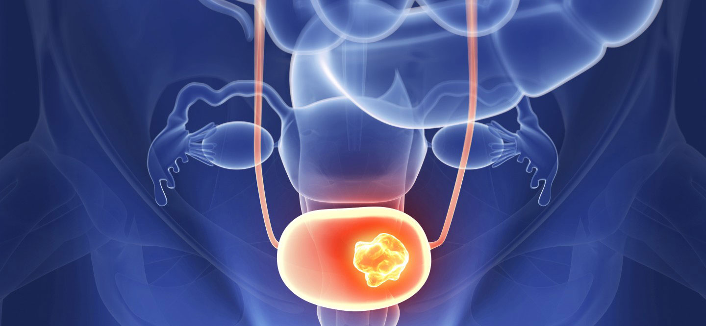 Interstitial cystitis