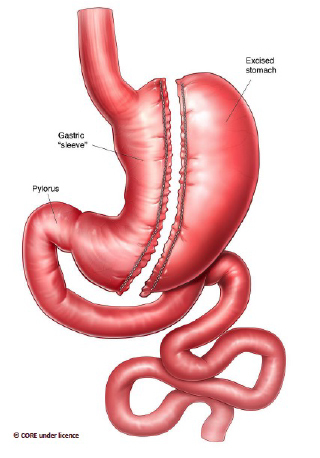 Surgeries to Treat Obesity